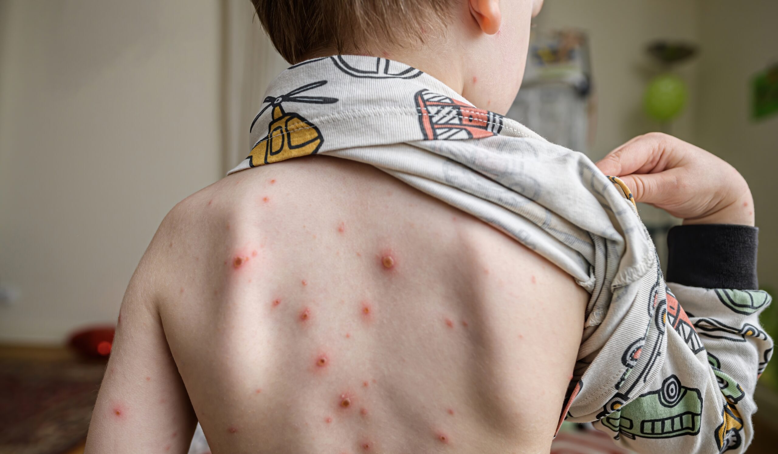 Barn med skoldkopper